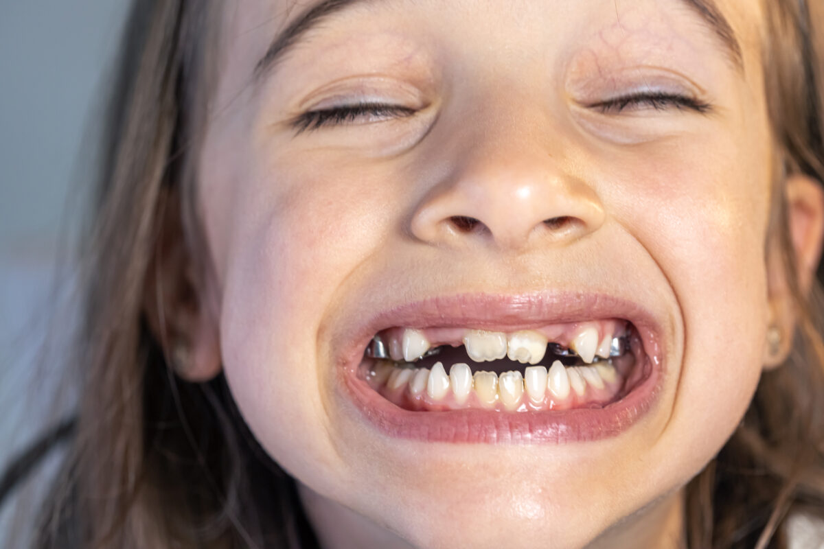 Niña mostrando sus dientes de leche en consulta odontopediátrica infantil