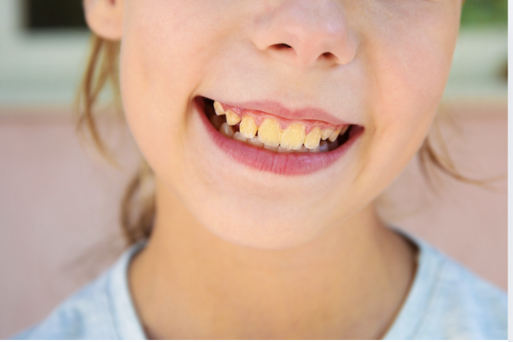 Niño sonriendo para ilustrar el tema de dientes amarillos en niños.