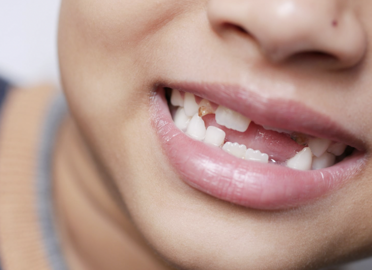 Bebé con diente roto para ilustrar qué hacer ante un traumatismo dental infantil.