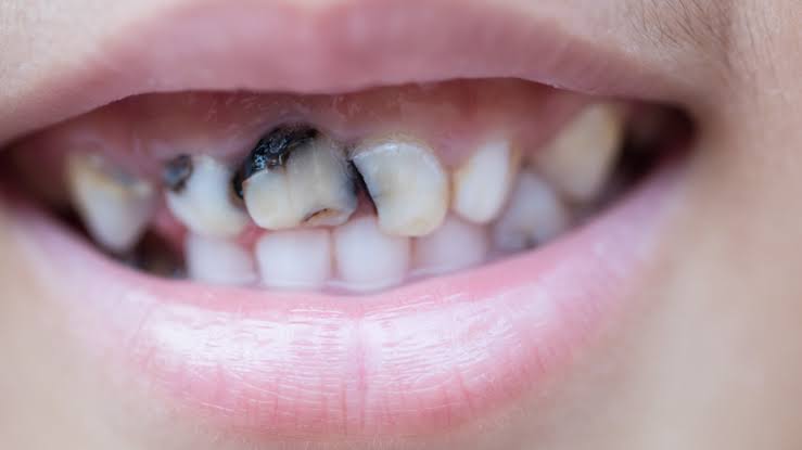 Niño sonriendo para ilustrar el tema de dientes negros o manchas oscuras en niños.
